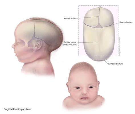 Sagittal Suture Ridge