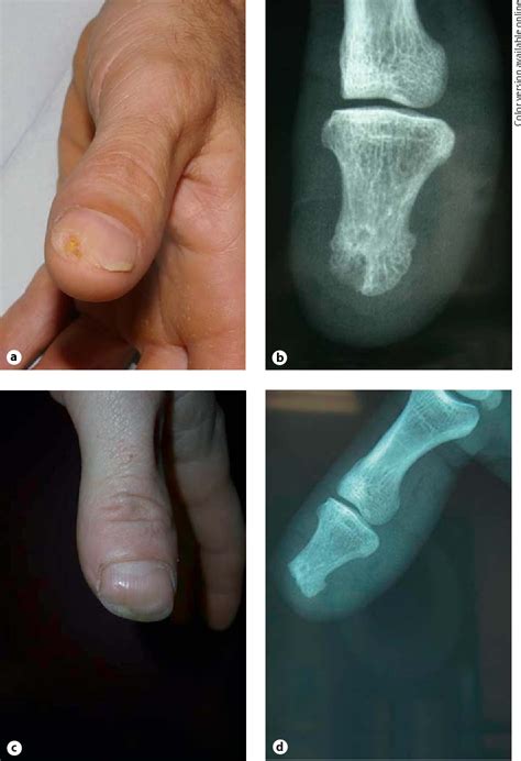 Figure 1 From Solitary Subungual Keratoacanthoma Arising In An Msh2