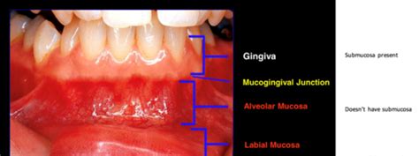 270 Normal Vs Diseased Periodontium Flashcards Quizlet