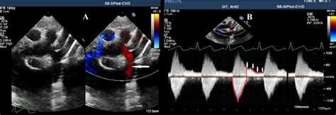 Holodiastolic Flow Reversal In The Distal Portion Of The Aortic Arch