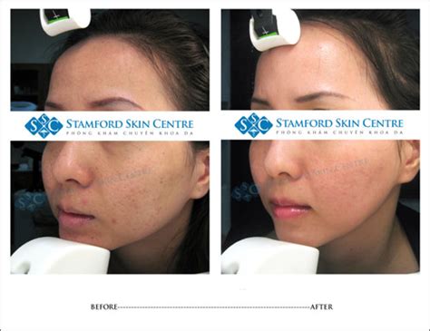 Stamford Skin Centre Tự Hào 10 Năm Với 15000 Ca điều Trị Da Thành Công