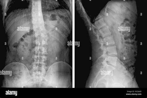 Xray Of Scoliosis Hi Res Stock Photography And Images Alamy