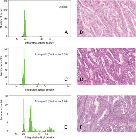 Prognostic Importance Of DNA Ploidy And DNA Index In Stage I And II