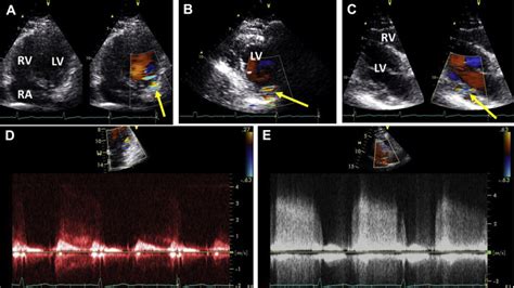 Coronary Cameral Fistula Preliminary Diagnosis According To Colour And