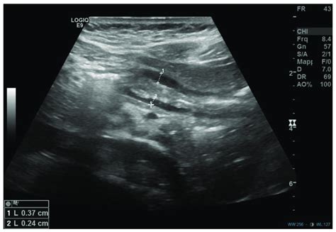 Post-operative abdominal ultrasound showing regular caliber of the ...