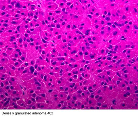 Pathology Outlines Pituitary Adenoma