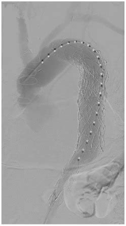 Multidisciplinary Hybrid Approach To Management Of A Thoracoabdominal