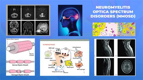 JU NJOFTOJMË ME SËMUNDJET E RRALLA NEUROMIELITIS OPTIKA Сакам Да Кажам