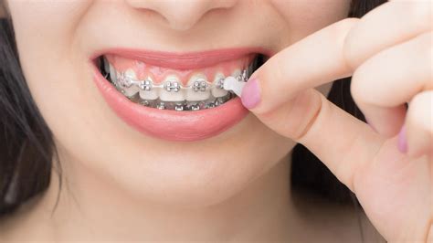 Can You Eat With Orthodontic Wax Dos And Don Ts For Braces Wearers