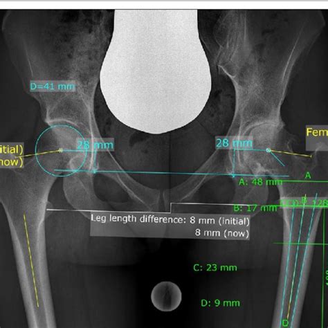 Preoperative Measurements Both Sides Femoral Offset Fo Acetabular Download Scientific