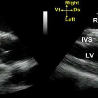 Magem Ecocardiogr Fica Representando O Corte Transversal Dos