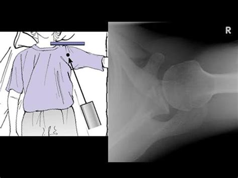 Shoulder Imaging - Shoulder & Elbow - Orthobullets