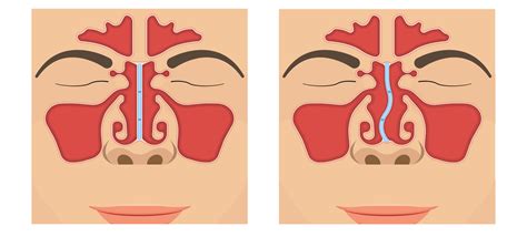 Nasal Septum