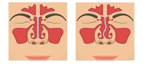 Deviated Septum - Dr. Aykut Unsal | Philadelphia