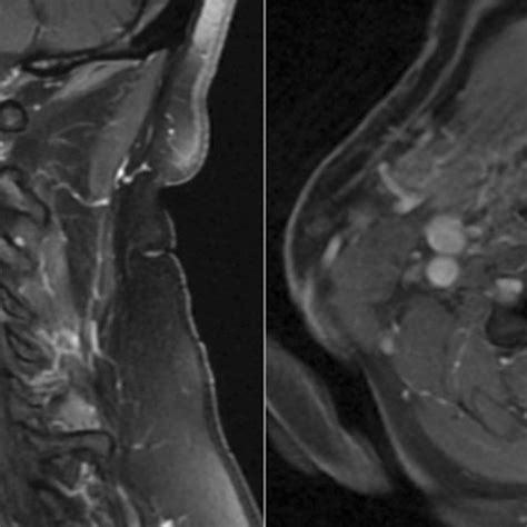 Preoperative MRI of the cervical spine with contrast. Imaging shows a ...