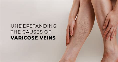 Varicose Veins Causes Symptoms Treatment Options In Dubai