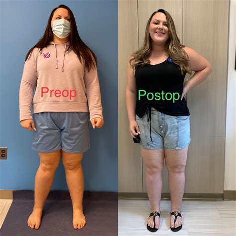 Knock Knee Deformity Before And After Photos Limb Lengthening