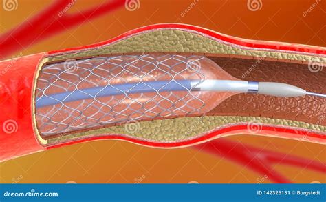 Stent Implantation For Supporting Blood Circulation Into Blood Vessels