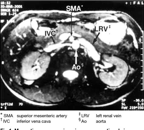 Figure 2 From Nutcracker Phenomenon Presenting As Left Varicocele