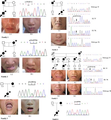 Pedigrees Of The Van Der Woude Syndrome Vws Families The Black