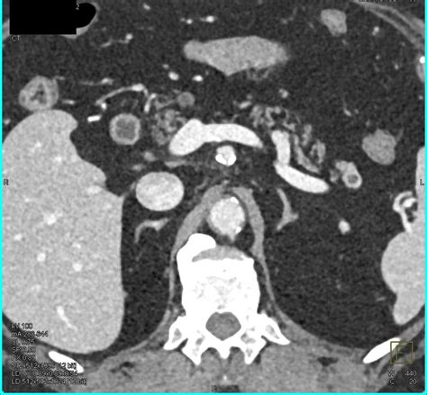 Cm Neuroendocrine Tumor In The Tail Of The Pancreas Pancreas Case