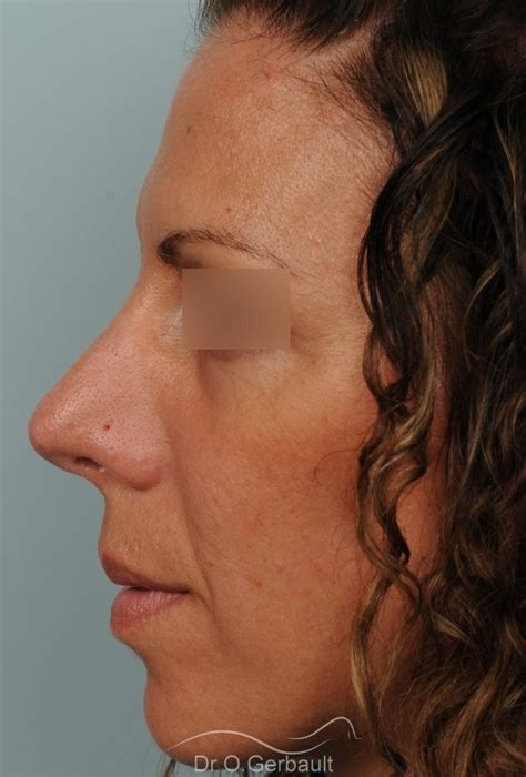 Photos De Rhinoplastie Avec Nez Trop Large Avant Et Apr S R Duire Le Nez