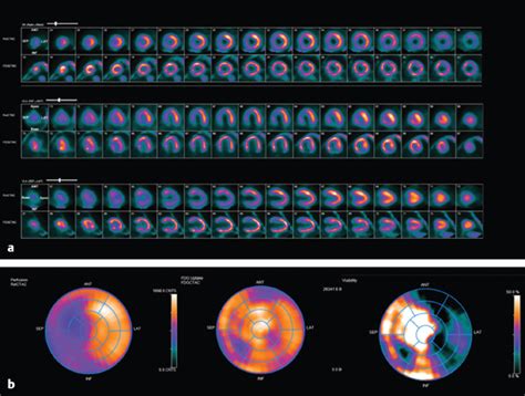 5 SPECT and SPECT/CT for the Cardiovascular System | Radiology Key