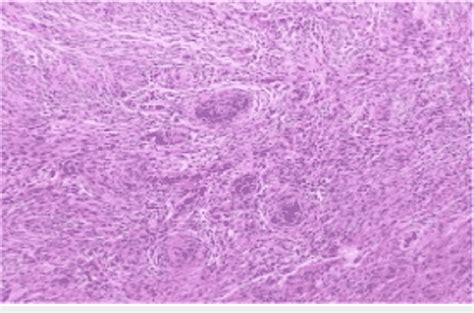 H E Stain Showing WHO Grade 1 Meningothelial Meningioma H E