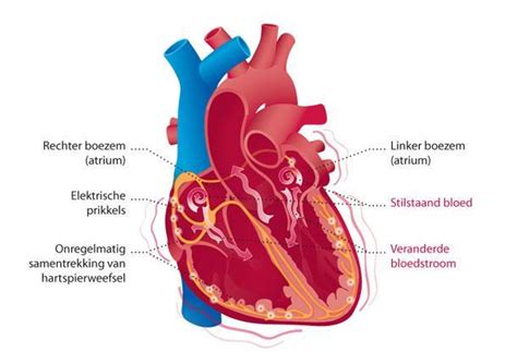 What Is Boezemfibrilleren Meest Boezemfibrilleren