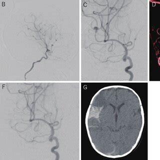 A And B Show Preoperative Cerebral Angiography Frontal And Lateral