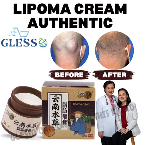 Lipoma Removal Cream Treat Tumor Skin Swelling Ointment Natural ...