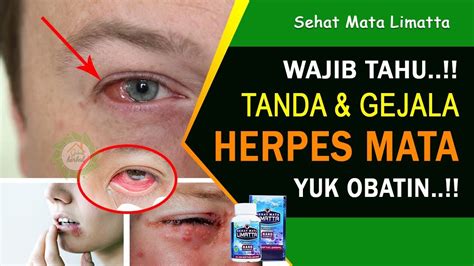 Gejala Penyakit Herpes Mata Sehat Mata Limatta YouTube