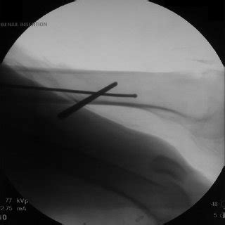 Intraoperative Anteroposterior Fluoroscopic Image Of The Femoral Nail