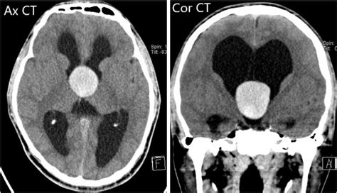 Nect Of The Brain Midline Third Ventricular Well Circumscribed Download Scientific Diagram