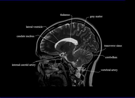 Cross Sectional Anatomy | MRI Brain Sagittal Anatomy | Free MRI brain ...