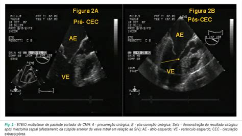 SciELO Brasil Ecocardiografia transesofágica intraoperatória na