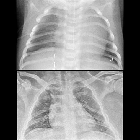 pediatric bifid rib pediatric radiology reference article pediatric