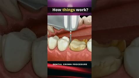 Dental Crown Procedure Dental Clinic