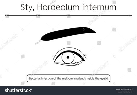 Discharge Eye: Over 271 Royalty-Free Licensable Stock Vectors & Vector ...