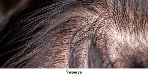 Segnali Che Indicano Una Futura Perdita Dei Capelli Insparya