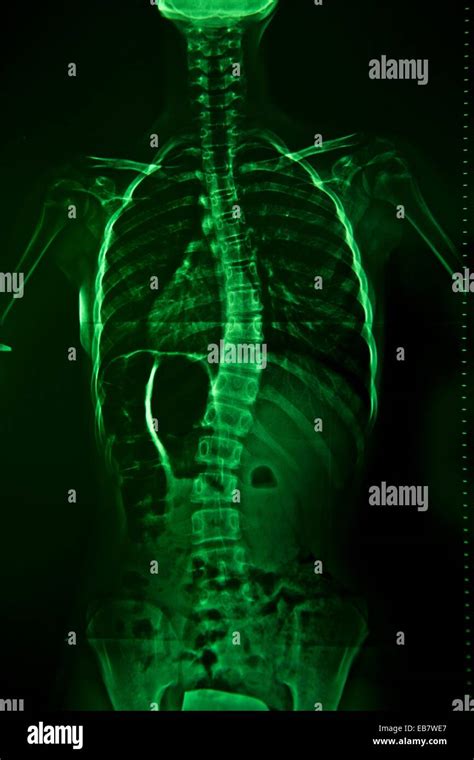 Scoliosis Spine Radiograph Stock Photo Alamy