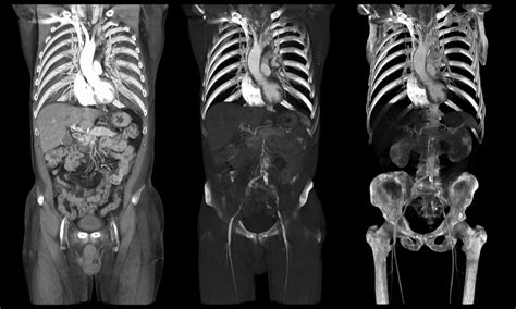 CT Scan Pelvis