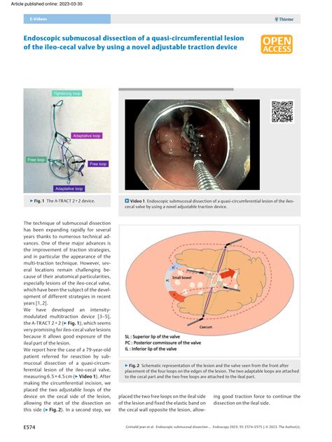 Pdf Endoscopic Submucosal Dissection Of A Quasi Circumferential Lesion Of The Ileo Cecal Valve