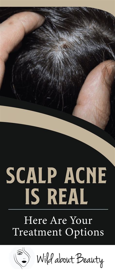 Scalp Acne is Real – Here are Your Treatment Options