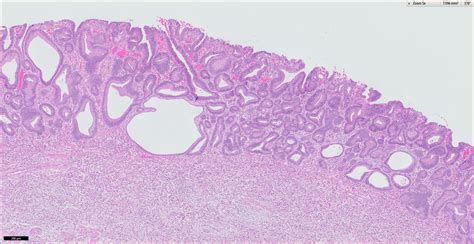 Pathology Outlines Inflammatory Fibroid Polyp