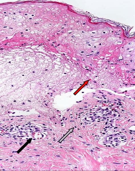 Erythema Multiforme Oral Histology