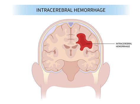 Intracerebral Hemorrhage Aurora Health Care