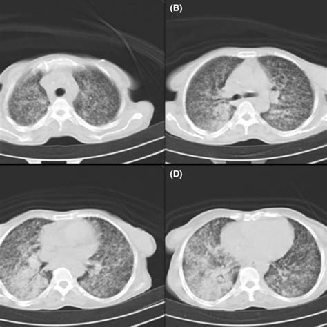 Fna Biopsy Of Solid Thyroid Nodule Demonstrates Isolated And Loose Download Scientific Diagram