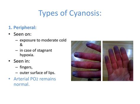 Cyanosis Blue Hands Feet Causes Treatment Diagnosis 47 Off