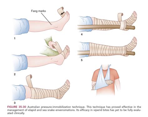 Pressure Immobilization Dressing Wikem